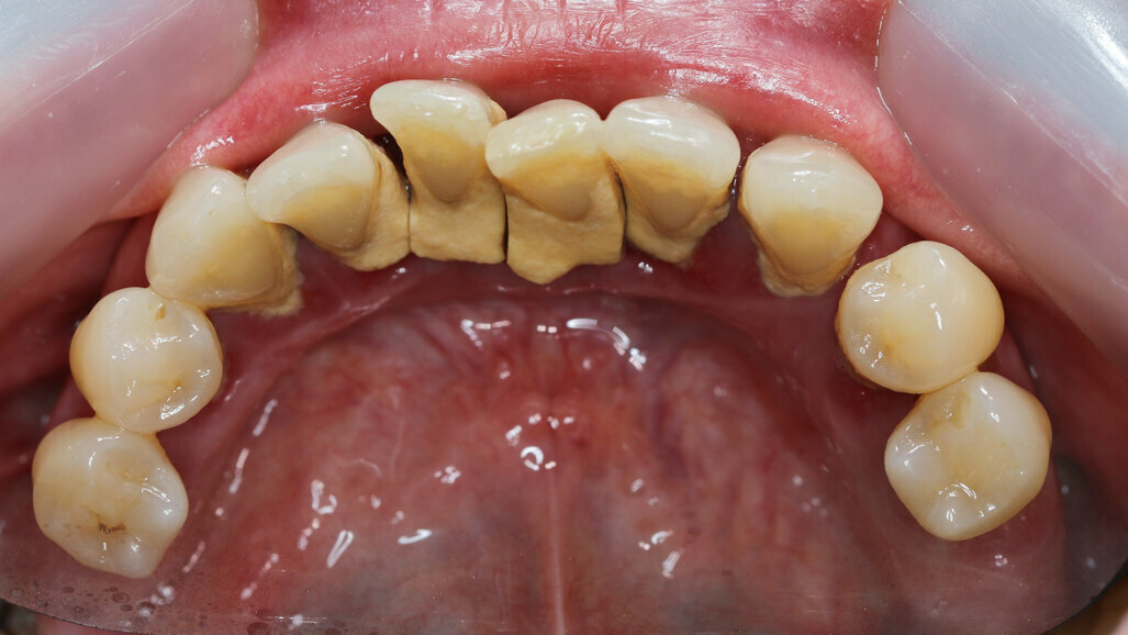 chronic periodontitis